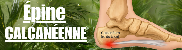 Épine Calcanéenne : Causes, Symptômes et Solutions pour Soulager la Douleur au Talon