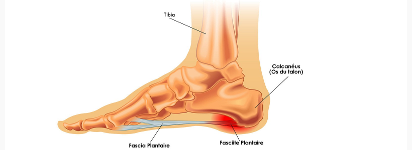 Fasciite Plantaire : Causes, Symptômes et 7 Solutions pour Soulager la Douleur